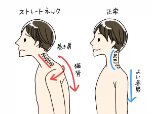 ストレートネックを浅草橋で改善。
